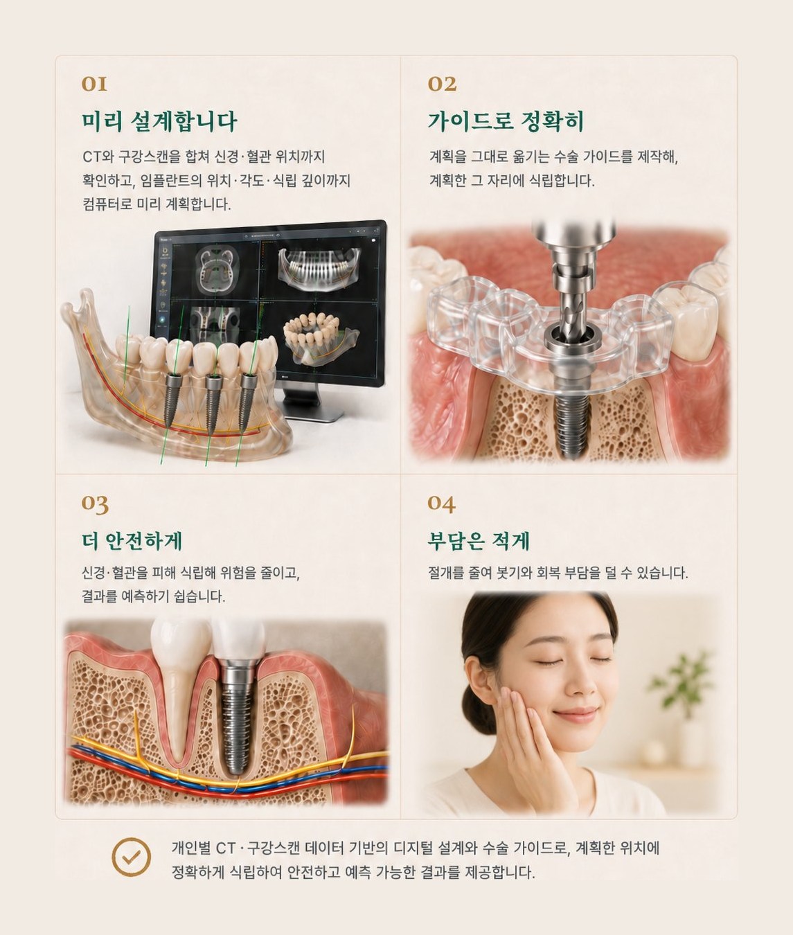 디지털 임플란트 4단계. ① 미리 설계 — 신경·혈관 위치까지 확인하고 위치·각도·깊이를 컴퓨터로 계획. ② 가이드로 정확히 — 수술 가이드로 계획한 자리에 식립. ③ 더 안전하게 — 신경·혈관을 피해 위험을 줄이고 결과 예측. ④ 부담은 적게 — 절개를 줄여 회복 부담 감소.